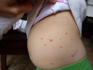 Kids Health: Molluscum Contagiosum